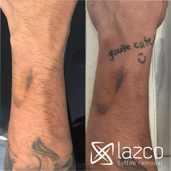 Recording laser tattoo removal damages ...